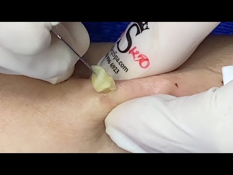 Satisfying Steatocystoma Popping