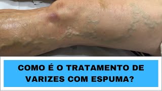 COMO É FEITO O TRATAMENTO DE VARIZES COM ESPUMA ( ESCLEROTERAPIA COM ESPUMA )