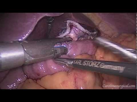 Laparoscopic Roux-en-Y Gastric Bypass