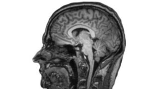Dyscalculia - Numberphile