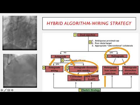 Decoding CTO PCI 4 : ADR after failed AWE in a RCA CTO with CKD