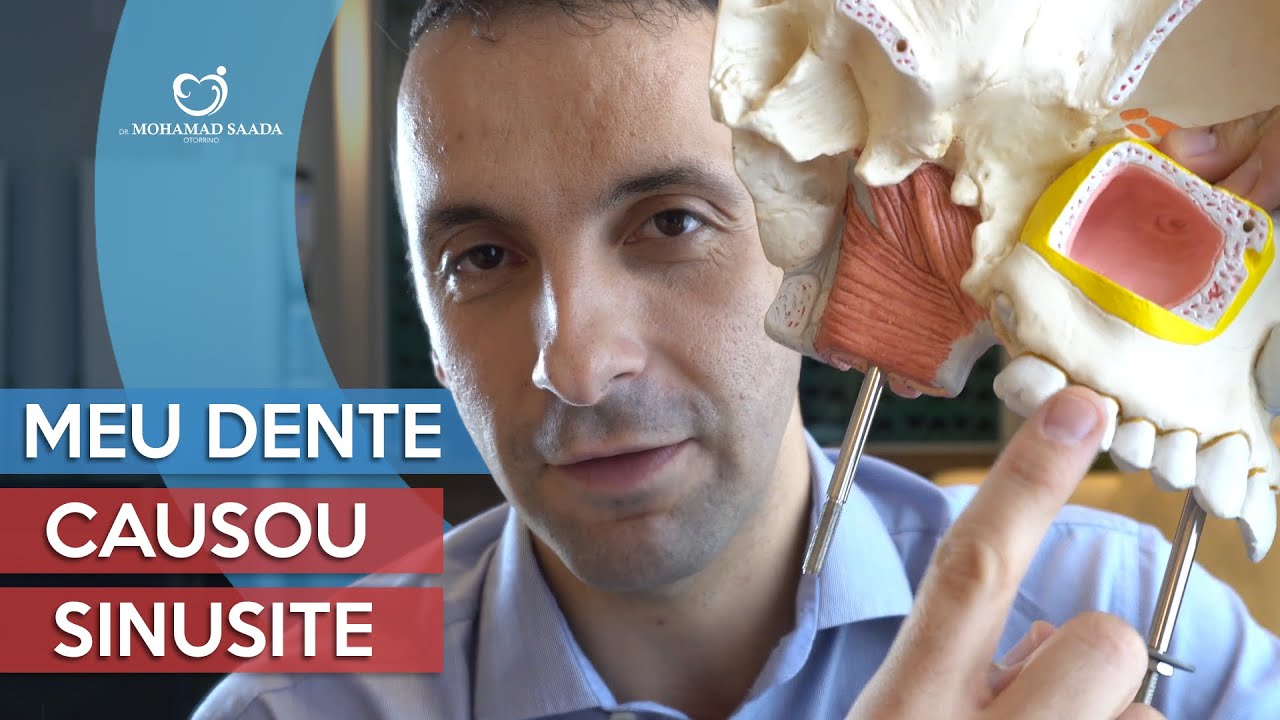 Meu Dente Causou Sinusite. Como um problema dentário pode causar Sinusite? Eu vou te explicar
