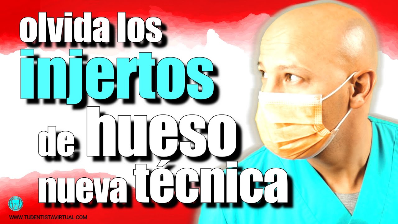 EXPANSIÓN ÓSEA cuando no hay HUESO, no hace falta INJERTO