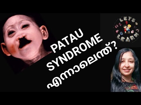 17.  PATAU SYNDROME- Trisomy 13 explanation in malayalam