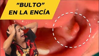 Bulto en la encía