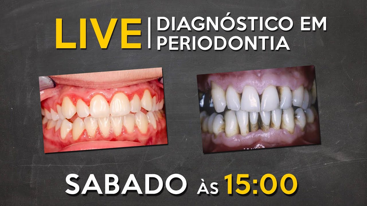 LIVE #045 - Diagnóstico em Periodontia