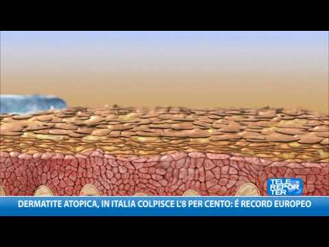 Siccome è possibile confermare la psoriasi Cura invasiva di psoriasi