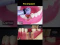How Is Dental Implant