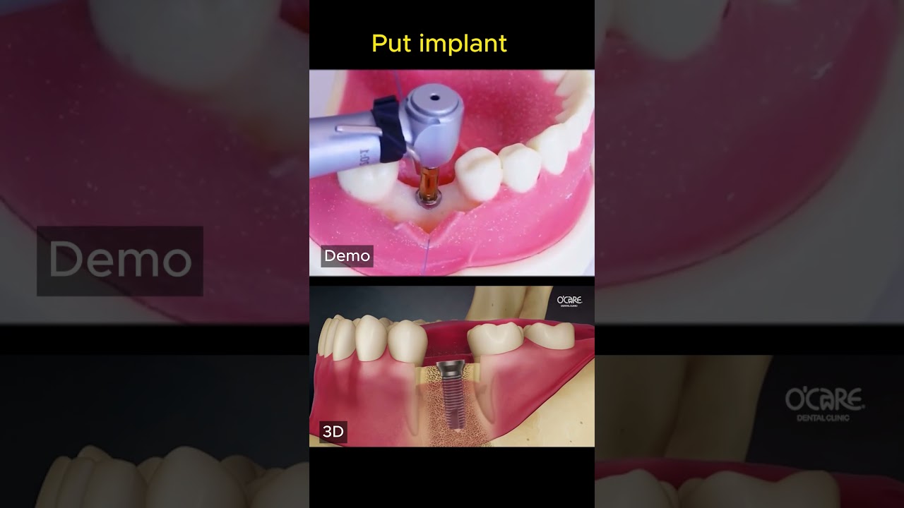 How is dental implant?