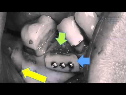 Wie funktioniert eine Knochentransplantation im Kiefer?