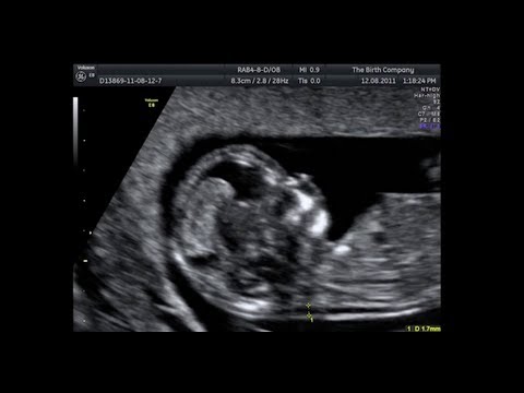 Nuchal Translucency Scan (11 Weeks - 14 Weeks)