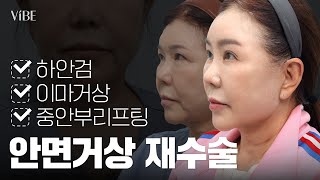 [성형 VLOG] 안면거상 칼귀교정! 이마거상 & 하안검까지 수술준비, 상담, 경과과정📹 재수술 고민이라면 필수시청!