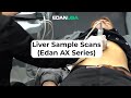 Liver Ultrasound Demo Scan (Edan/Acclarix AX Series)