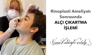 Cast Removal After Rhinoplasty Surgery