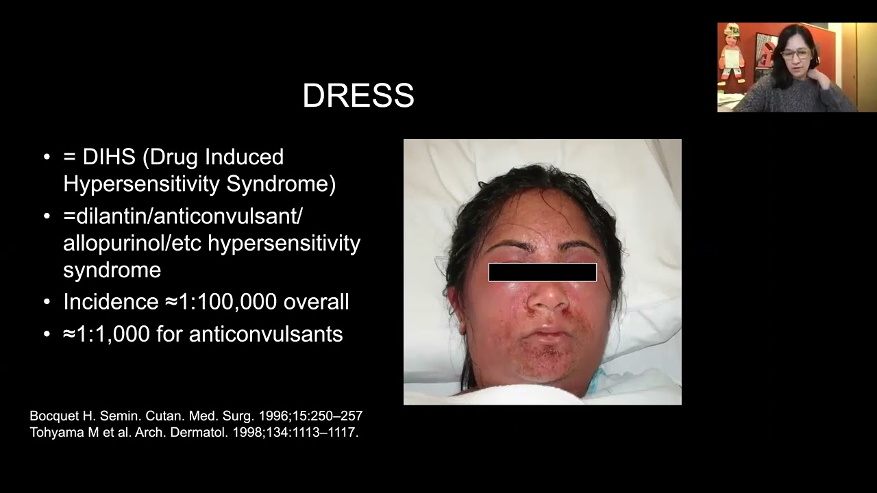 Drug Reactions with Eosinophilia and Systemic Symptoms (DRESS): A Dermatologist’s Perspective