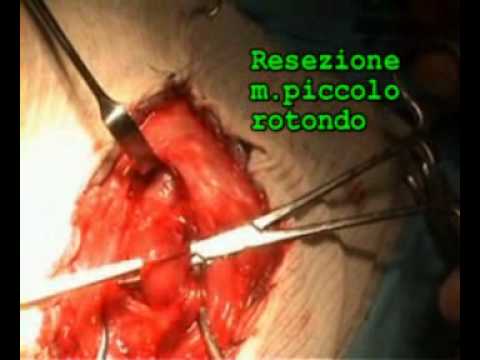 Dolore nella parte destra della schiena Ortesi per i bambini dellarticolazione del ginocchio