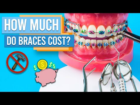 YouTube video about: How much do braces cost in utah?