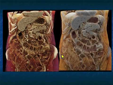 CT Evaluation of Small Bowel Obstruction - Part 4