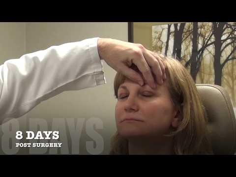 Jessica Upper Eyelid Post-Op Surgery