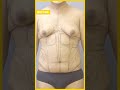 Transgender 360 Transformation Care Before After Results Liposuction Hourglass Shorts