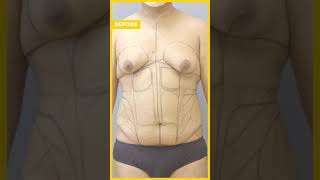 Transgender 360° Transformation Care Before &amp; After Results #liposuction #hourglass #shorts