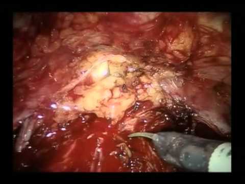 Radical Robotic Cystectomy With Intracorporeal Urinary Diversion - Part 1