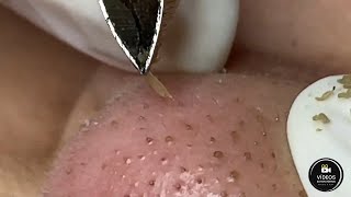 Espremendo Cravos e Espinhas - Relaxante e Satisfatório 😍