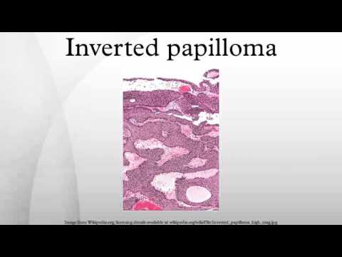 Treatment for inverted papilloma sinus