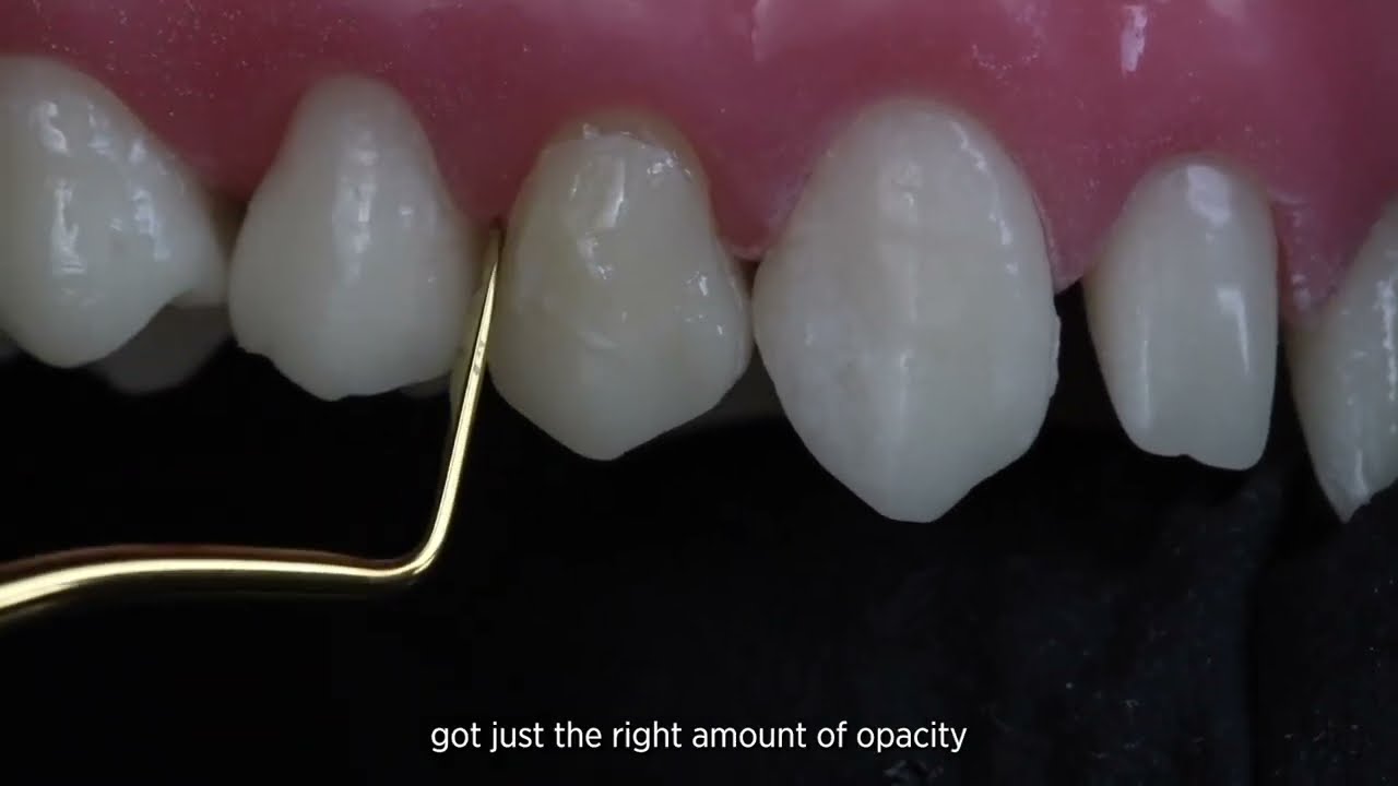 Class V Composite Restoration with Rhodri Thomas, BDS
