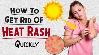 How to Get Rid of Heat Rash Quickly | Home Remedies for Heat Rashes Treatment