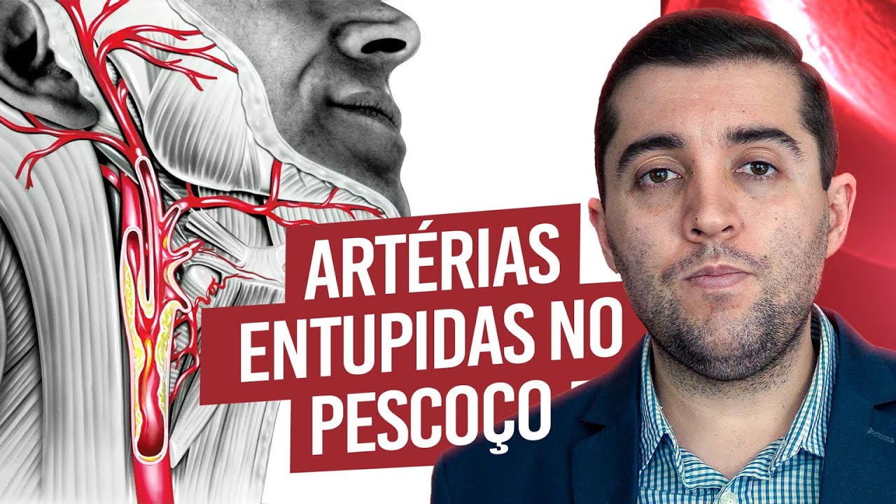 Placas nas carótidas e artérias entupidas no pescoço: qual a relação com o AVC, trombose e embolia