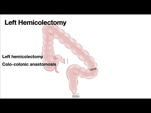 HCC 1475 10j  Surgical Anatomy Left hemicolectomy