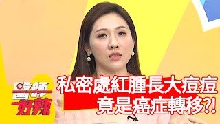 私密處紅腫長大痘痘，竟是癌症轉移？！【#醫師好辣】20201210 part1 EP1065 陳依依 田知學