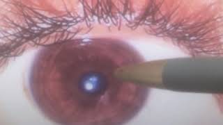 Nerve and cholesterol rings, chronic bowels - an interesting eye reading