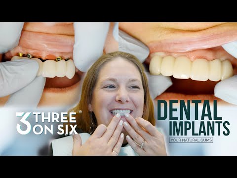 From Abscesses to New Teeth - The 3 on 6 is Natural Looking and Natural Feeling