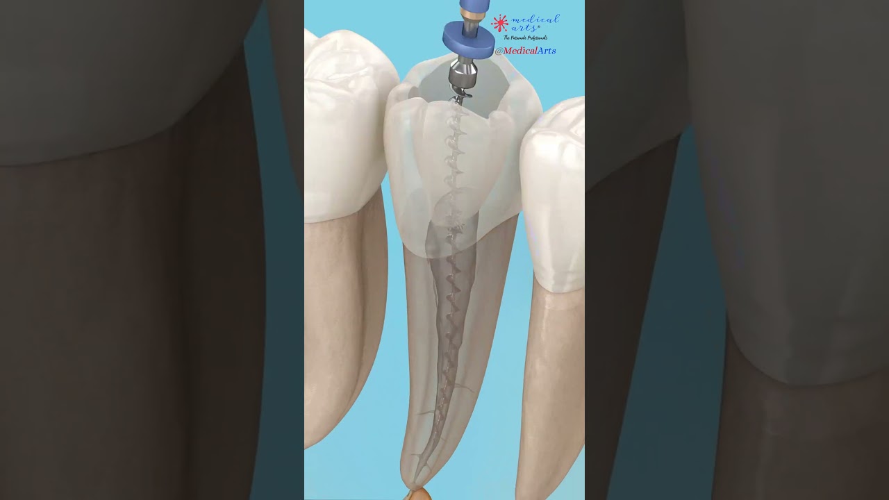 What happens inside a root canal? 🦷 The Dentist Clinic 😷