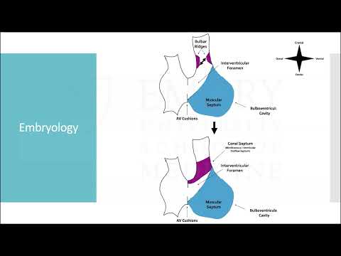 Congenital Ventricular Septal Defects (VSD) in Adults