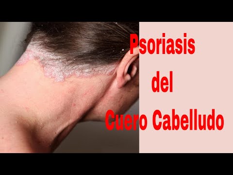 La psoriasis en la forma puesta en marcha de la consecuencia Neyrodermit o la alergia