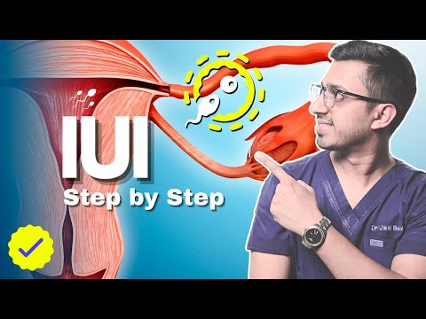 Intra Uterine Insemination (IUI) - A Simple Guide