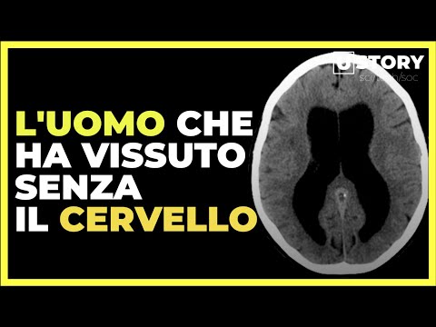 Storie incredibili: l'uomo senza cervello, ecco la sua storia