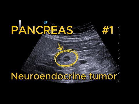 Neuroendocrine Tumor G1 – Hypoechoic video preview