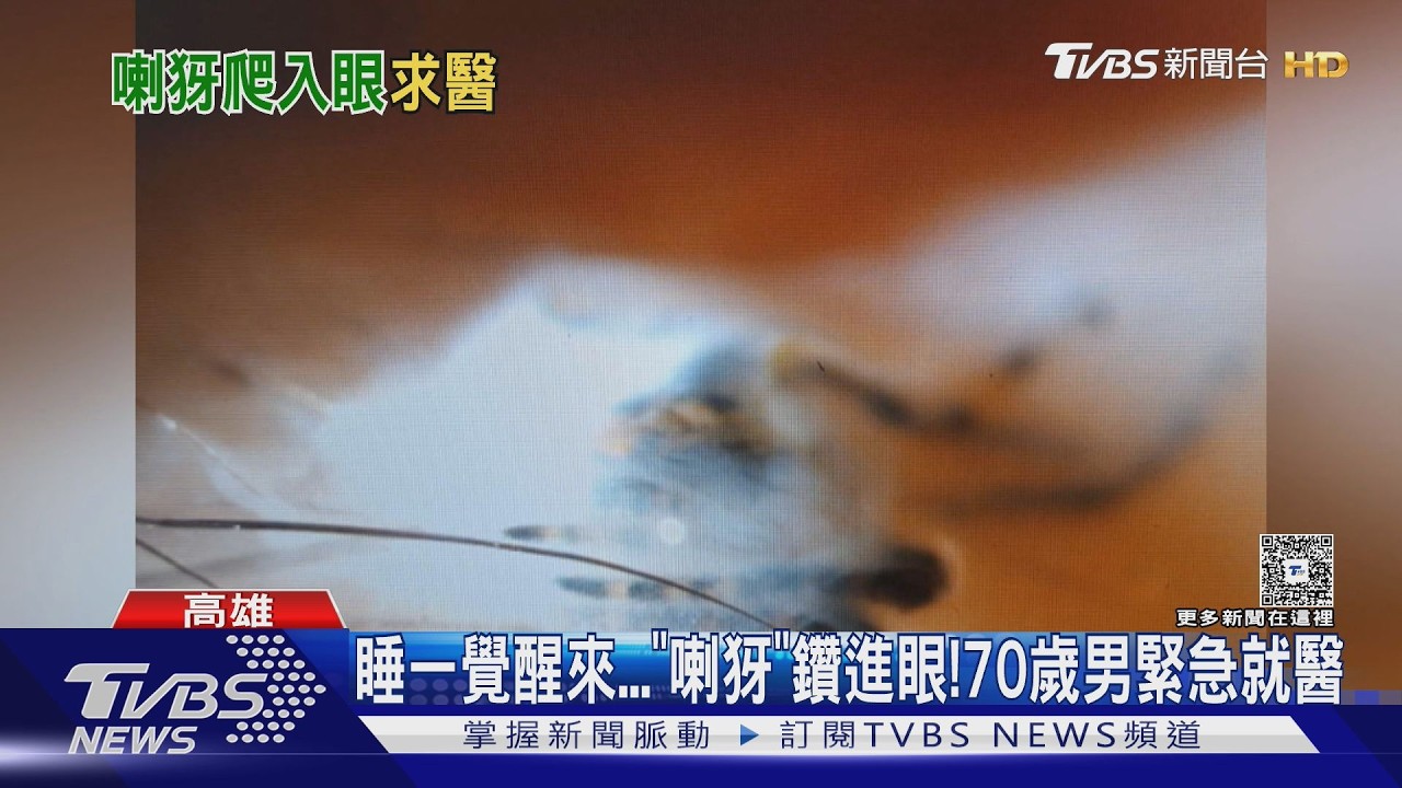 影音/睡一覺「喇犽」鑽進眼! 70歲男緊急就醫 醫師夾出殘骸嚇壞