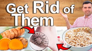 GET RID of CRACKED HEELS Permanently! - How to Treat Dry, Cracked Feet NOW - Moisturize and Cure