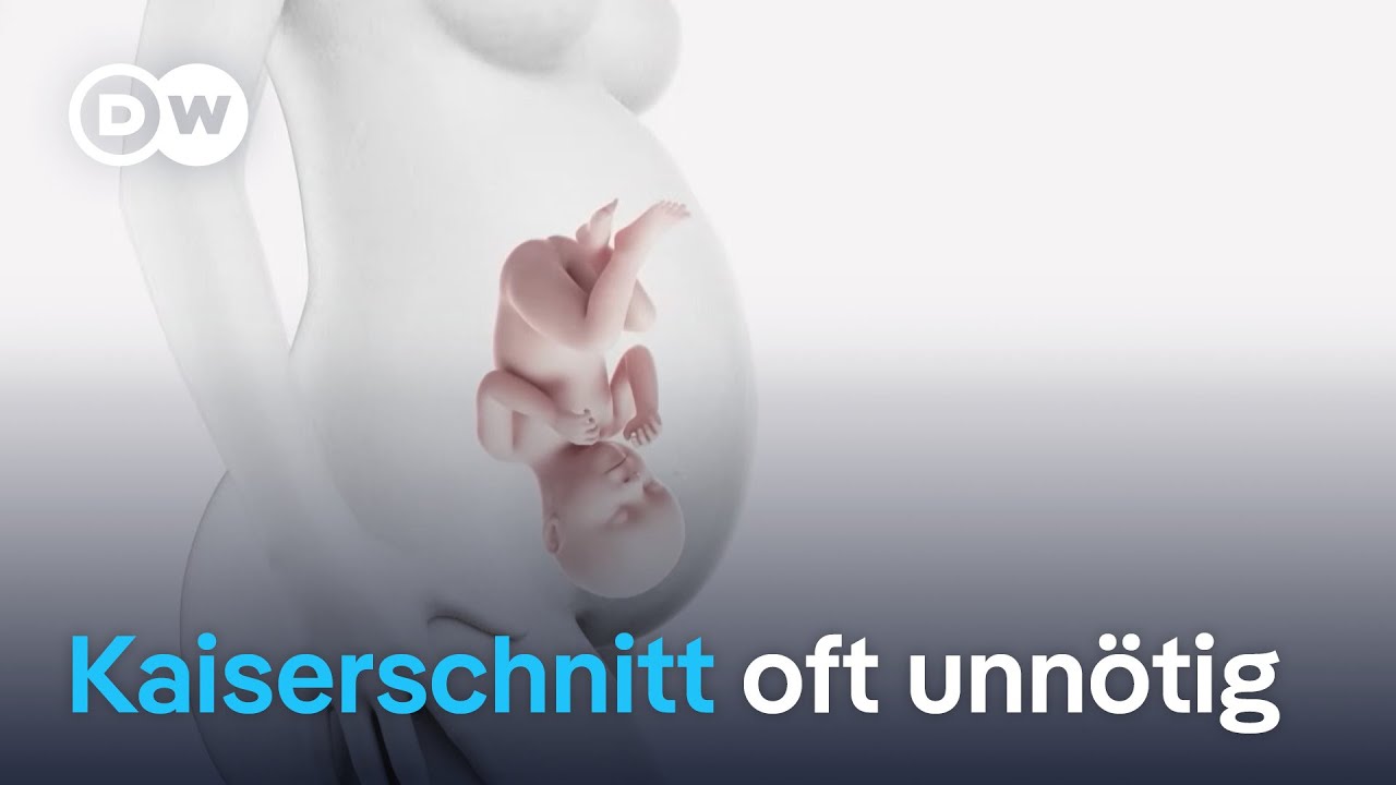 Warum diese Ärzte viele Kaiserschnitte für unnötig halten | DW Nachrichten