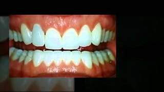 preview picture of video 'dentures | 919-867-0516 | Louisburg | Franklin County | 27549 | dental bridge | dental partials'