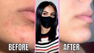 maskne - how to get rid of mask rash and maskne fast and prevent it from coming back