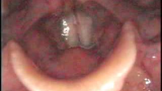 Vocal cord paralysis case