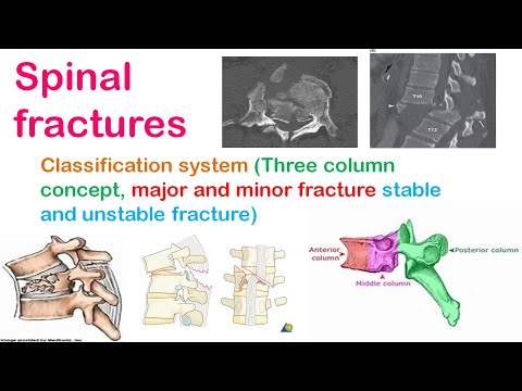 Spinal fracture classification system: Three column concept, Major-minor, Stable-unstable fracture.