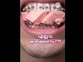 ഞാൻ എല്ലാം കഴിക്കും Braces Kambi Pallilkambiidunnath Viralshorts R