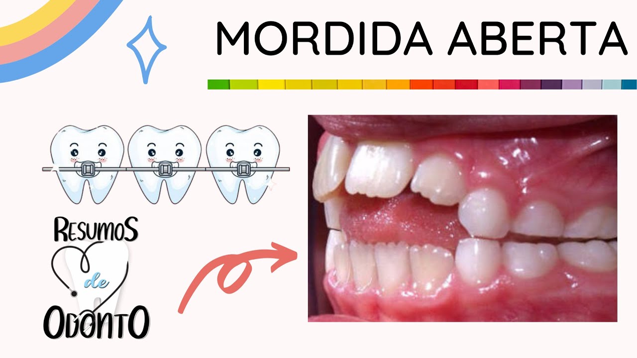 MORDIDA ABERTA - ANTERIOR| POSTERIOR ou DENTÁRIA| ESQUELÉTICA